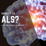 ALS treatment using umbilical cord stem cells
