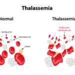 Thalassemia treatment using umbilical stem cells