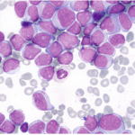 NK Cell Therapy in the Treatment of Acute Myeloid Leukemia